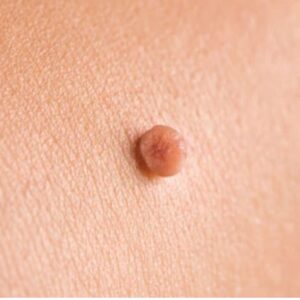 Level 4 Removal of Skin Blemishes, Skin Tags and Moles Using Non-Surgical Cosmetic Procedures